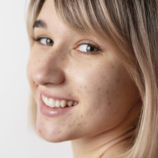 Una mujer joven con acné recibiendo tratamiento Peeling Fotoage por un dermatolog
