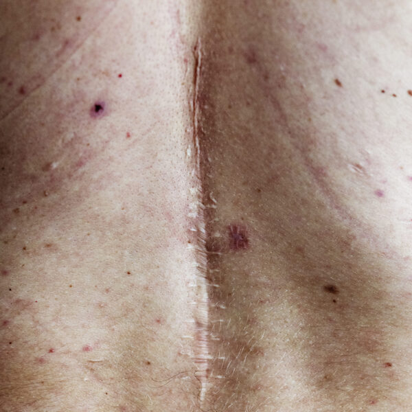 Tratamiento de cicatrices con dermatólogo