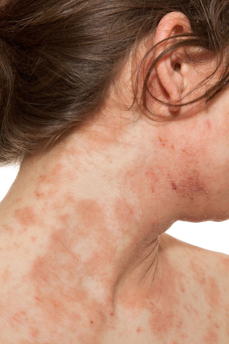 The 6 Most Common Types of Eczema — And How to Treat Them | Dermatricia