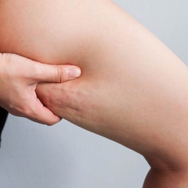 Como disminuir la celulitis de las piernas | Dermatricia