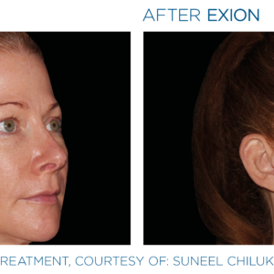 Exion PIC Ba card face female 030 Face ENUS100 | Dermatricia