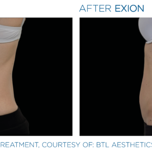 Exion PIC Ba card lateral abdomen female 034 Body ENUS100 | Dermatricia